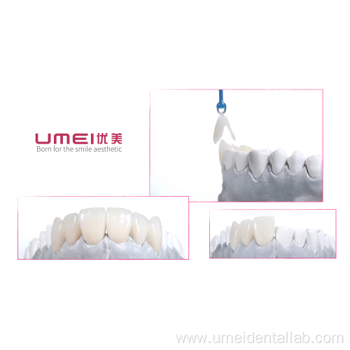 Veneer Crown Design